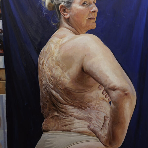Sylvia Mac, body positivity activist and burns survivor